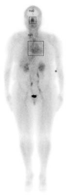 Nasal lymphatic obstruction of CSF drainage as a possible cause of Alzheimer’s disease and dementia